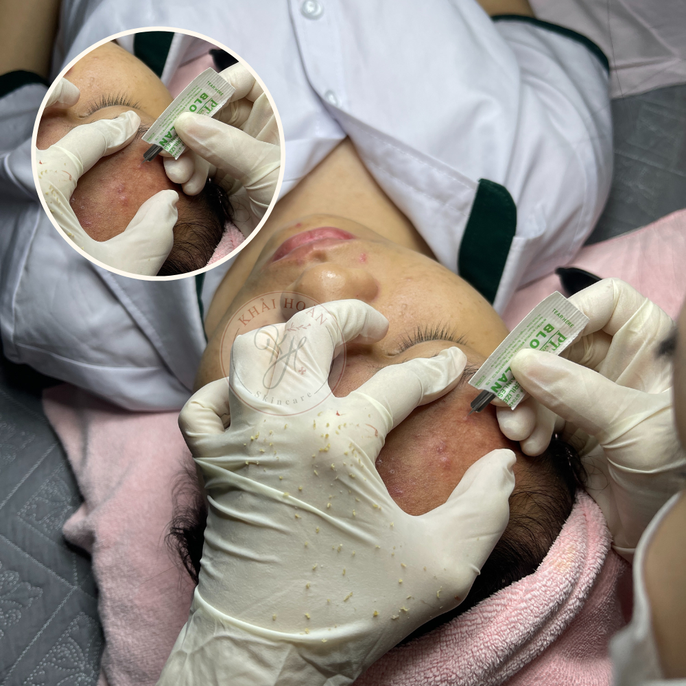 khaihoanskincare laynhanmun