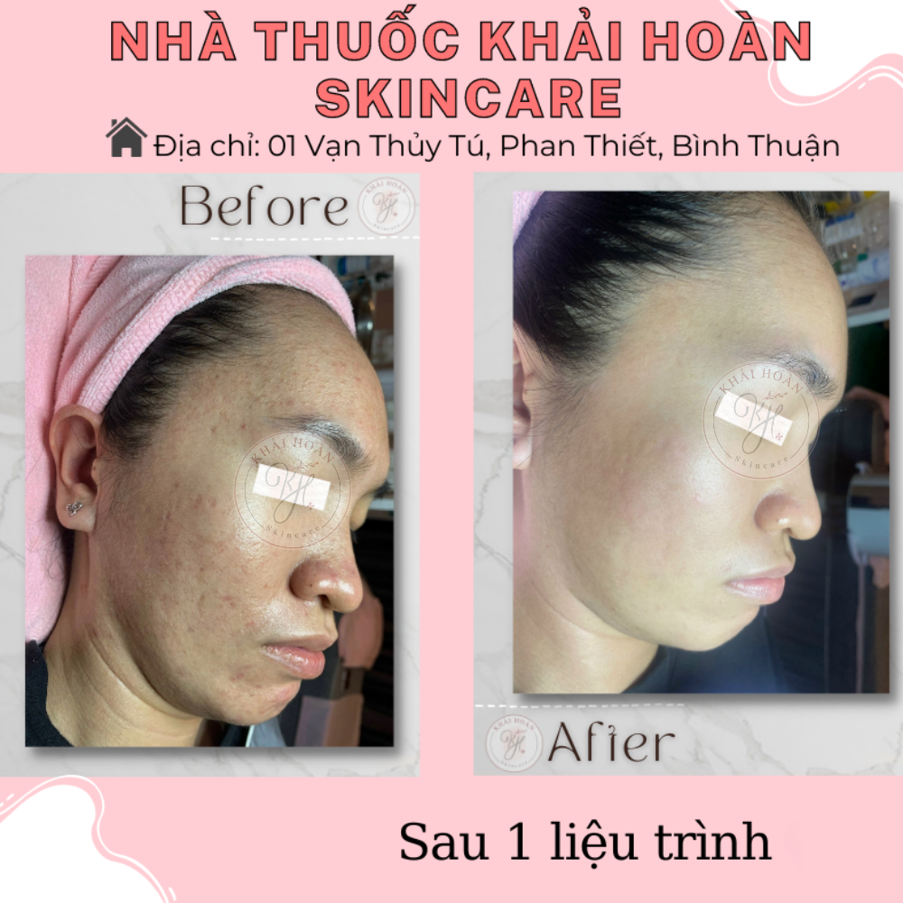 khaihoanskincare laynhanmun