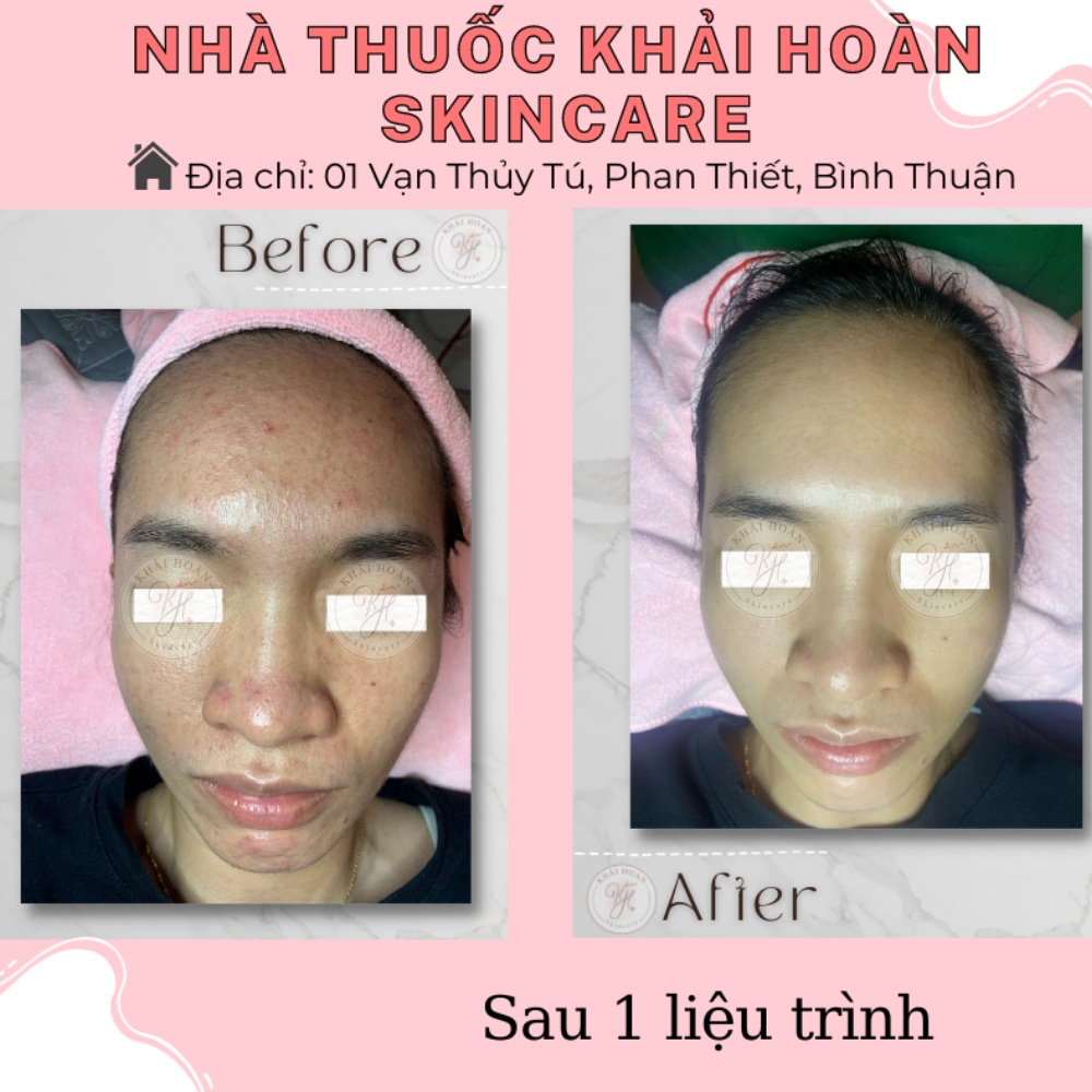 khaihoanskincare laynhanmun