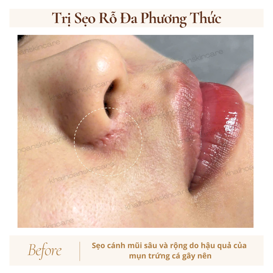 truoc dieu tri seo