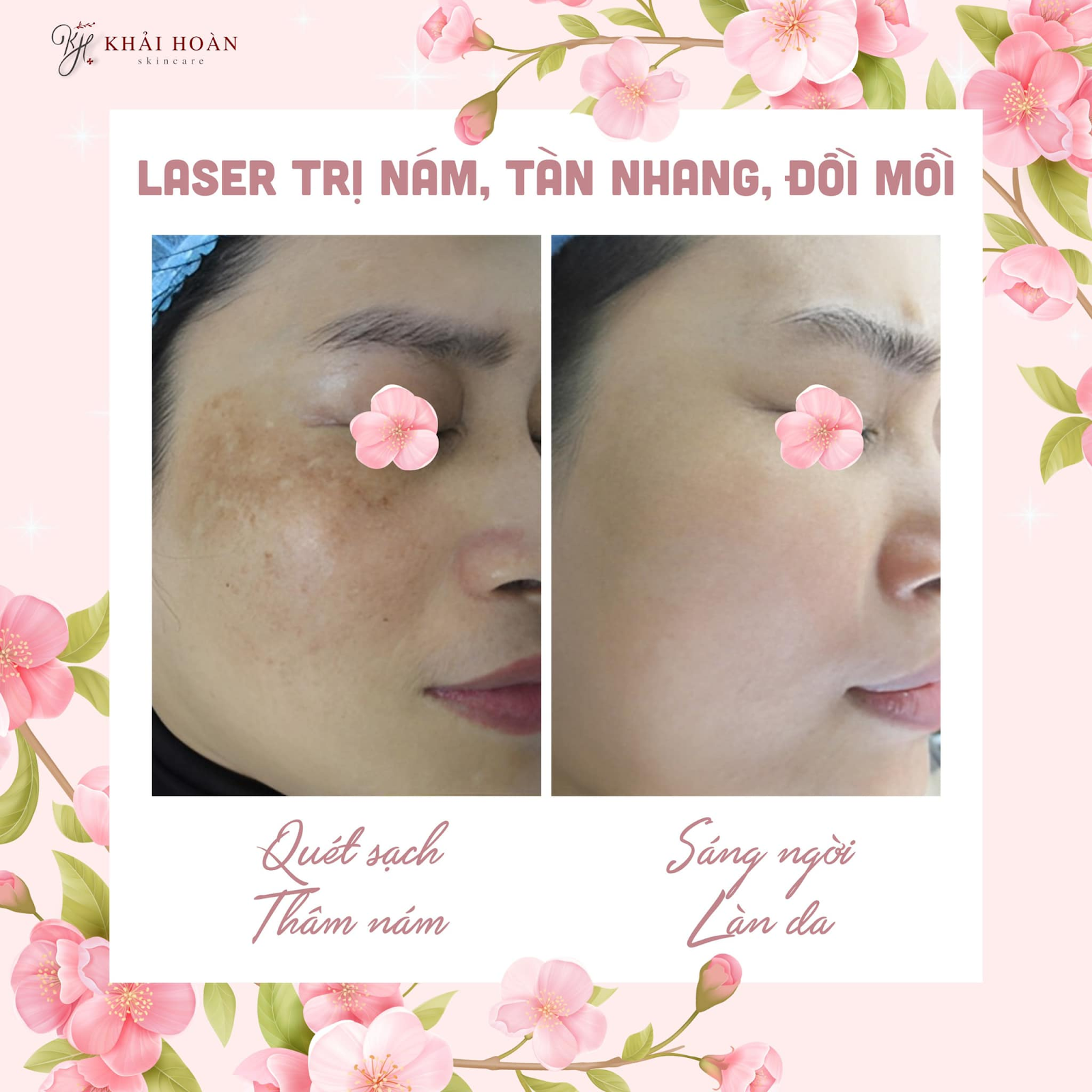 ban laser tri nam 1