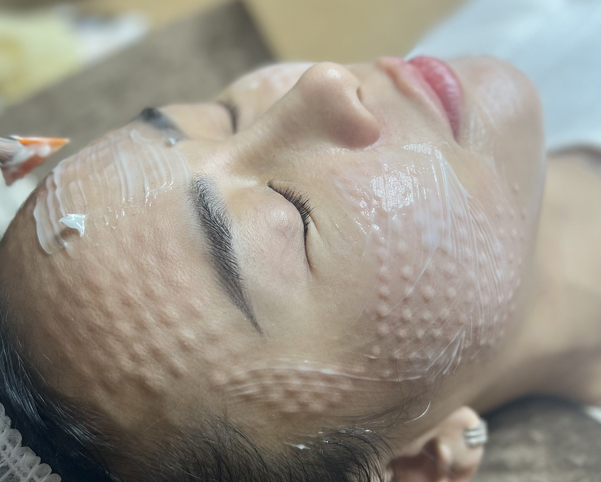 Tiêm Meso Là Gì? Có Nên Thực Hiện Không? Có Rủi Ro Không? 4 tiem meso la gi