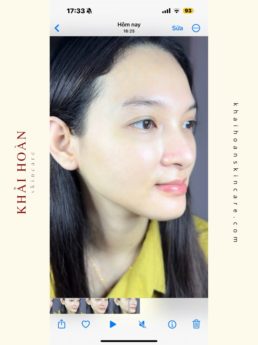 Tiêm Meso Là Gì? Có Nên Thực Hiện Không? Có Rủi Ro Không? 5 tiem meso la gi 1