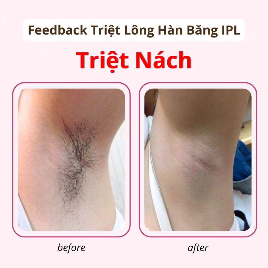 triet long la gi 2