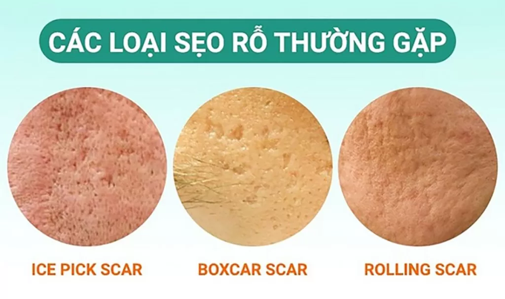 seo ro la gi 1