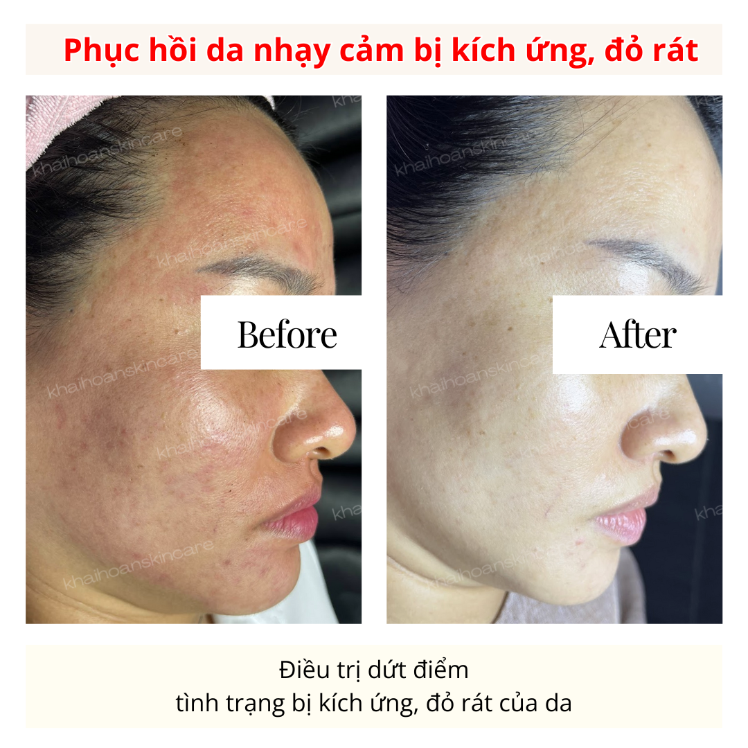 phuc hoi da 1