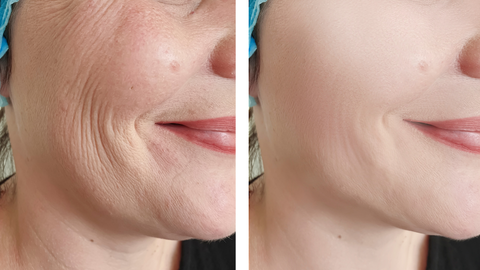 Xoá nhăn, chảy xệ