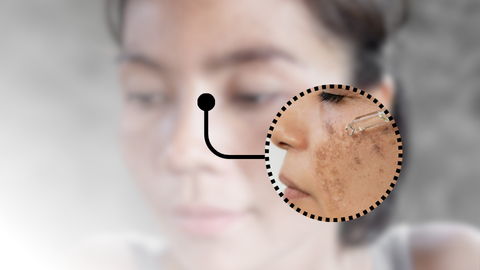 Phục hồi thâm, xạm, nám