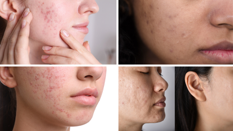 Xoá sẹo, mụn cóc